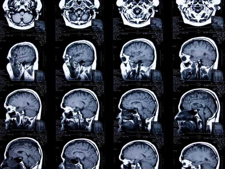 Torbiel szyszynki - przyczyny, objawy, diagnoza, leczenie