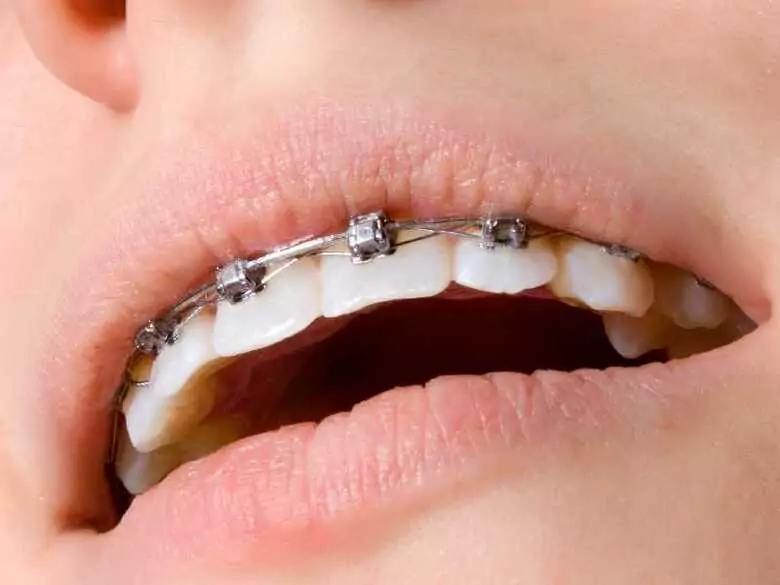 Nowoczesne aparaty ortodontyczne z zamkami samoligaturującymi