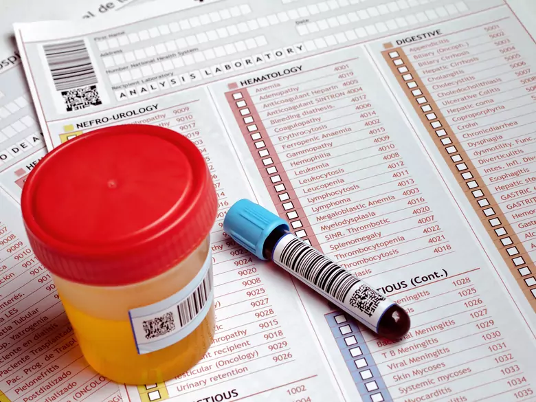 Pseudohypoparatyroidyzm - przyczyny, objawy, diagnoza, leczenie