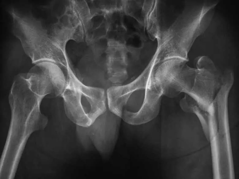 Łamliwość kości u kobiet w okresie około i postmenopauzalnym - przyczyny, objawy, diagnoza, leczenie