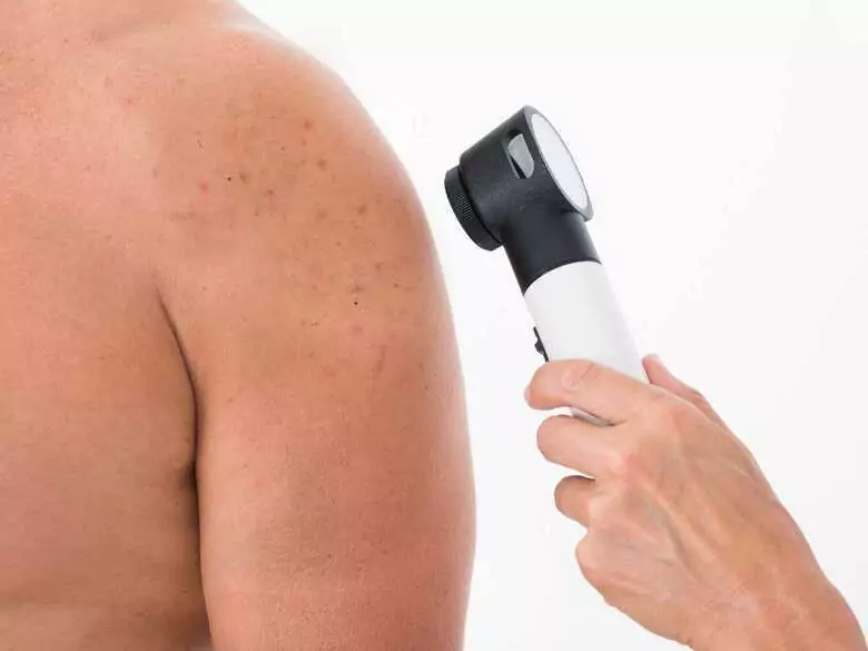 Znamiona pod kontrolą