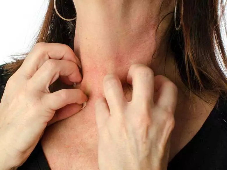 Epidemiologia alergii kontaktowej na nikiel