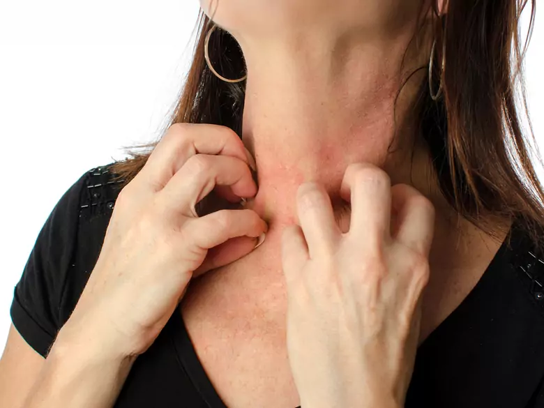 Epidemiologia alergii kontaktowej na nikiel