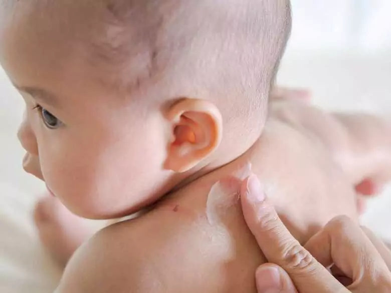 Wyprysk u dzieci – wpływ karmienia piersią