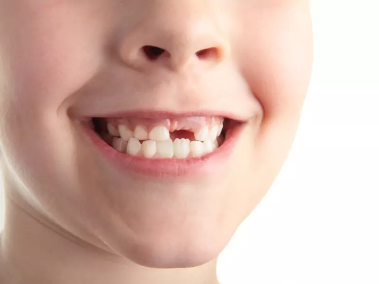 Próchnica mleczaków - przyczyny, objawy, diagnoza, leczenie