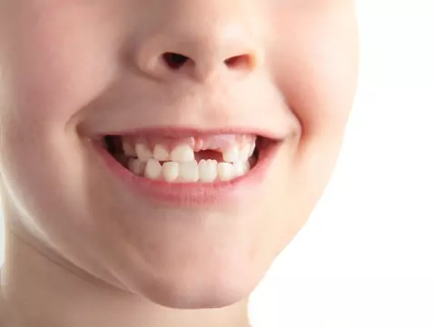 Próchnica mleczaków - przyczyny, objawy, diagnoza, leczenie