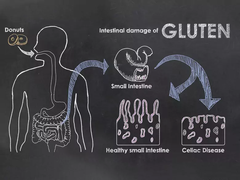 Osoby chore na celiakię mają większe ryzyko przedwczesnej śmierci
