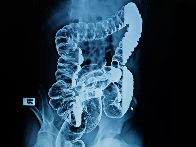 Angiodysplazja jelitowa - przyczyny, objawy, diagnoza, leczenie