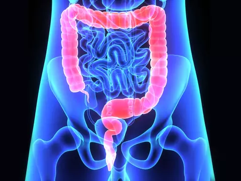 Rak odbytnicy – poznaj objawy i metody leczenia