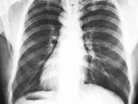 Zdjęcia RTG klatki piersiowej w kardiologii