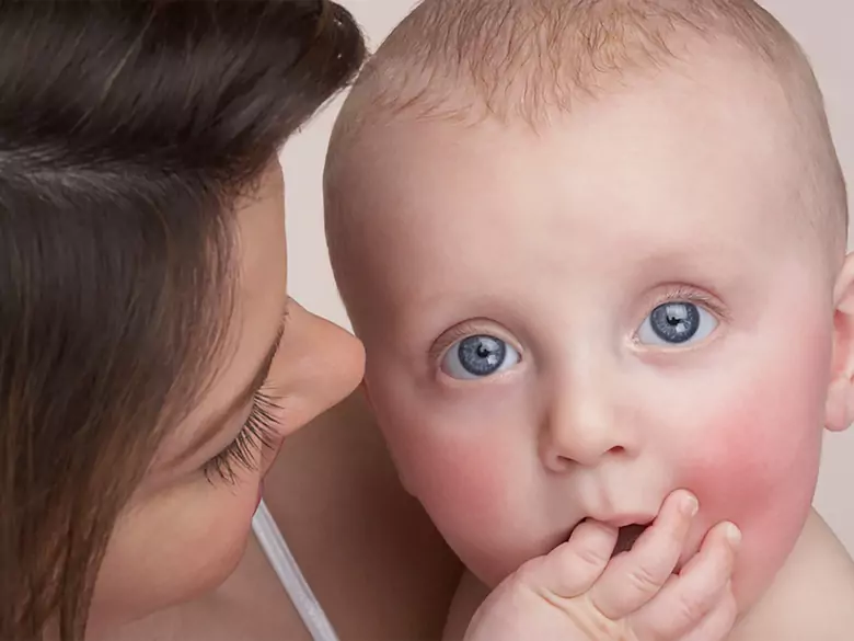 Odra - przyczyny, objawy, diagnoza, leczenie, powikłania