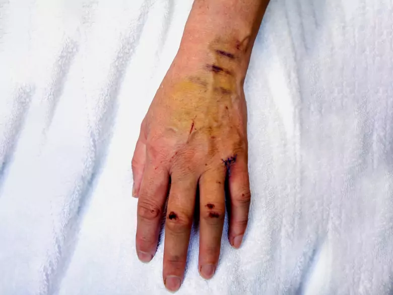 Zmęczenie, bladość, nietypowe siniaki. Seniorze, zwróć uwagę na te objawy