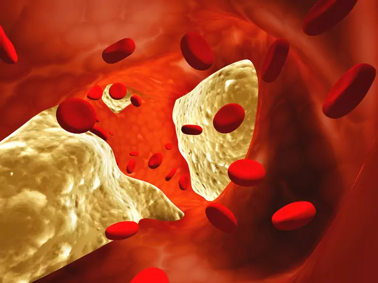 Tętniaki - groźna i podstępna choroba naczyń