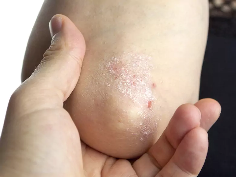 Czy łuszczyca to tylko problem skóry – jakie są psychiczne koszty choroby?