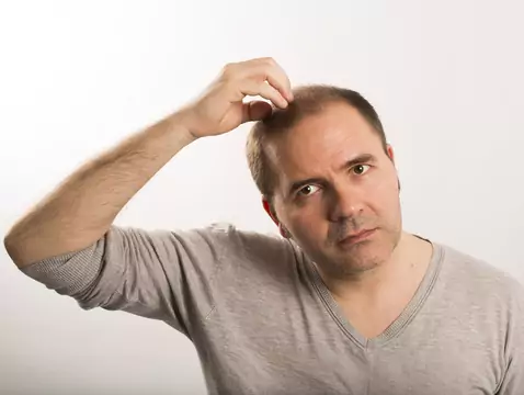 Niedobór witaminy D może sprzyjać łysieniu