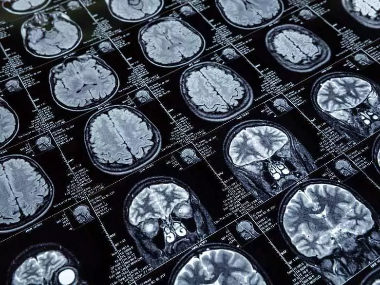 Zakrzepica zatok żylnych mózgu