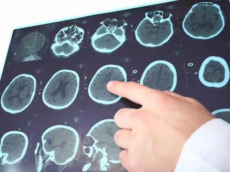 Prace nad nową metodą leczenia choroby Parkinsona i alternatywną drogą podawania leków