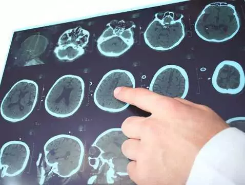 Co trzecia osoba w Unii Europejskiej zmaga się z chorobami mózgu