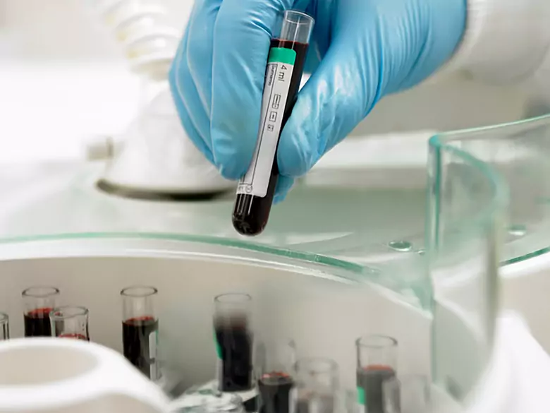 Anemia w ciąży - przyczyny, objawy, diagnoza, leczenie