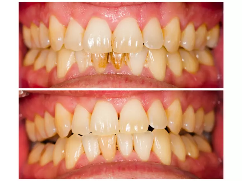 Ponad 46 proc. Polaków źle ocenia wygląd i stan swojego uzębienia