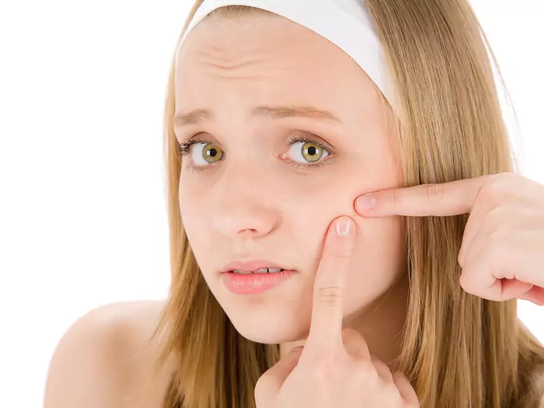 Patogeneza i leczenie trądziku zwyczajnego