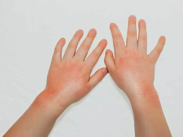 Czy istnieją domowe sposoby na pokrzywkę?