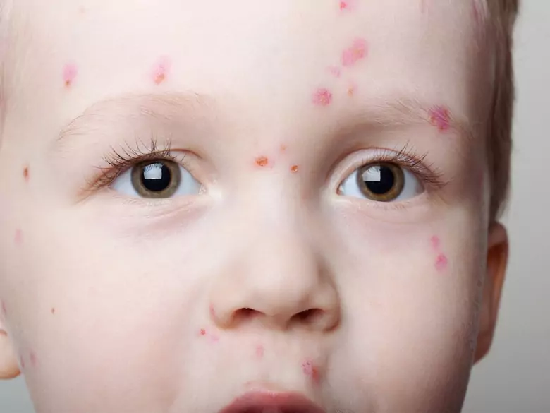 Ospa wietrzna - leczenie zmian skórnych