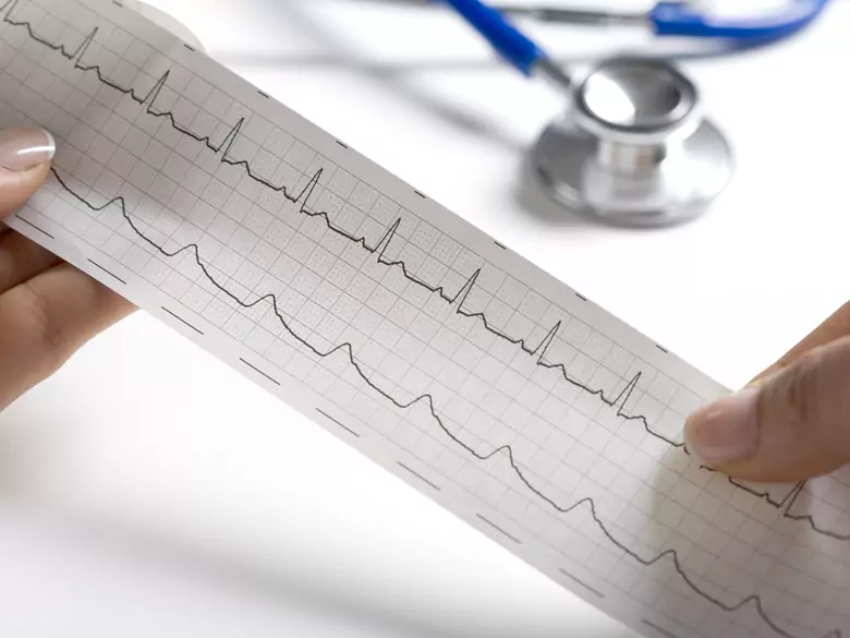 Niedokrwistość serca - przyczyny, objawy, diagnoza, leczenie