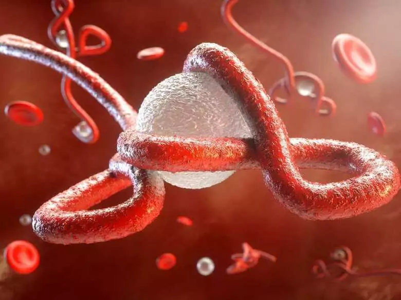 Hemochromatoza pierwotna - przyczyny, objawy, diagnoza, leczenie