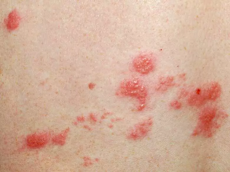 Zespół Sweeta – poznaj rzadką chorobę dermatologiczną