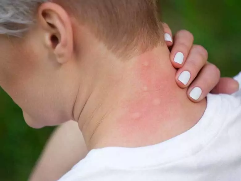 Pokrzywka kontaktowa: co ją wywołuje i jak ją leczyć?