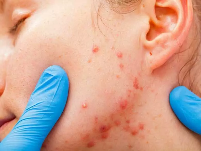 Trądzik: kiedy do dermatologa?