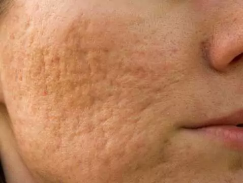 Biomikroigły wchodzą do domowej pielęgnacji. Trend gabinetowy przenosi się do domowych rytuałów