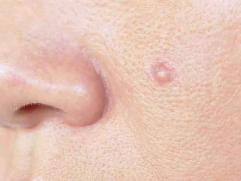 Nietypowe postacie trądziku różowatego