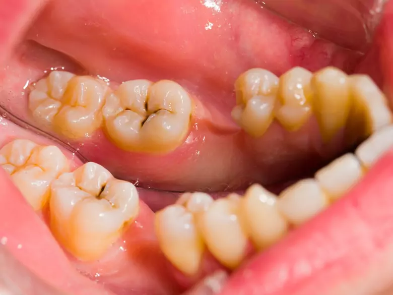 Operacja usunięcia zębów zatrzymanych