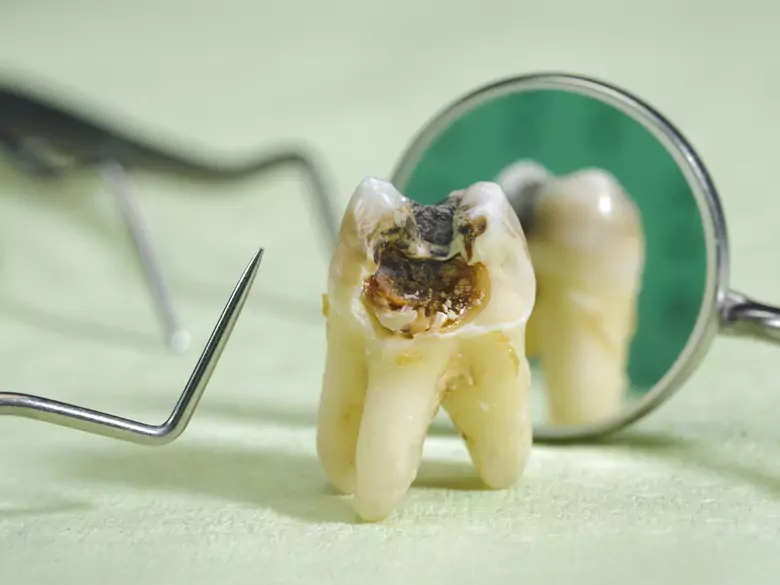  Zwichnięcie i wybicie zębów mlecznych  - przyczyny, objawy, diagnoza, leczenie