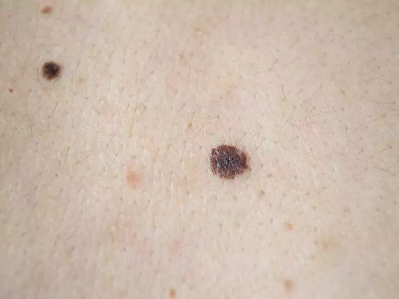 Dbaj o swoje znamiona - dlaczego warto wykonać dermatoskopię i chronić skórę przed słońcem?