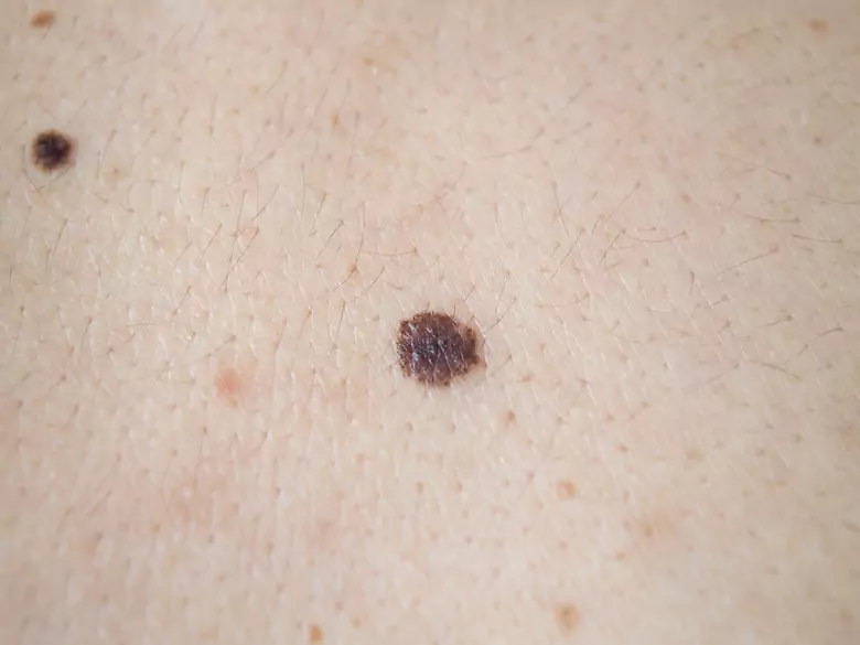 Dbaj o swoje znamiona - dlaczego warto wykonać dermatoskopię i chronić skórę przed słońcem?
