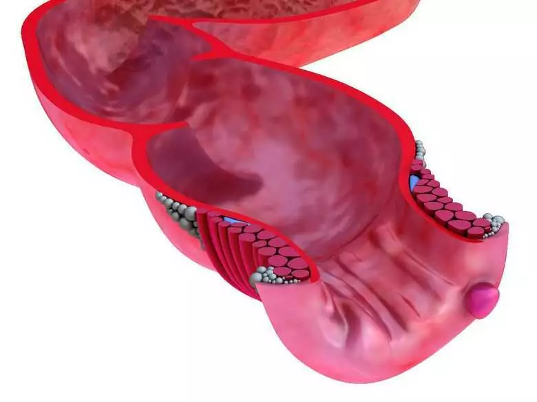 Powstawanie i rozwój zakrzepu - zakrzepica żył głębokich