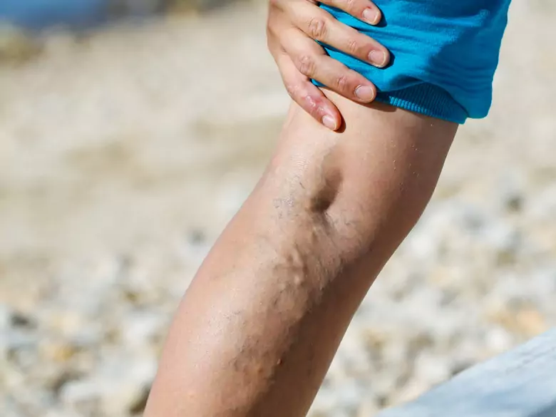 Żylaki to problem milionów Polaków. Jak skutecznie zapobiegać i leczyć?